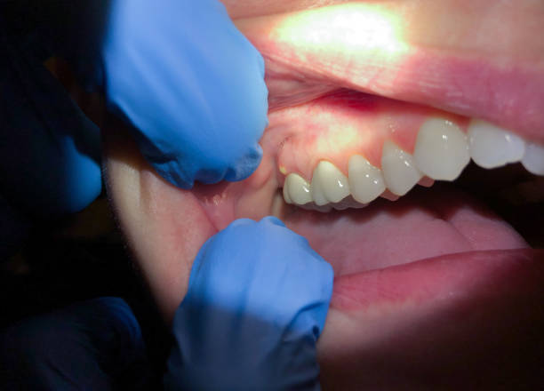 Best Emergency Treatment for Dental Infections or Abscesses in Belpre, OH