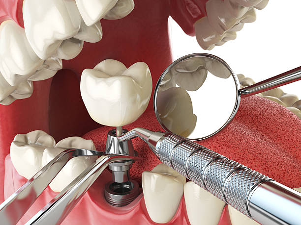 Best Emergency Dental Care for Broken or Chipped Teeth in Belpre, OH